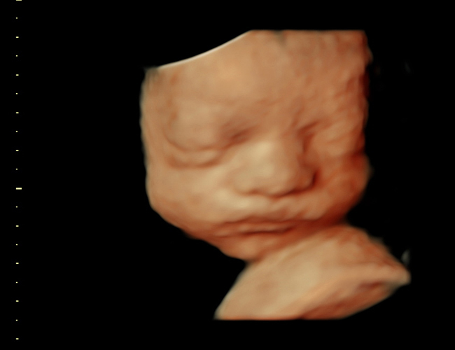 3D ultrasound image at 29 weeks